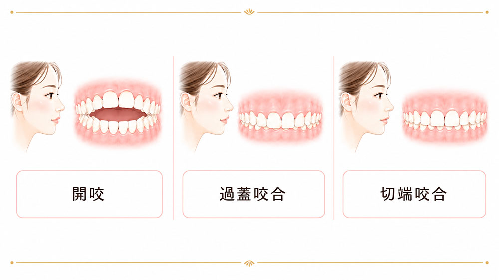 開咬・過蓋咬合・切端咬合の噛み合わせの違いを示した比較図