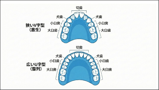 狭い歯列弓と理想的なアーチ形状の比較図