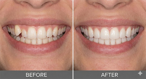 犬歯の飛び出し（八重歯）の矯正前後の比較イメージ