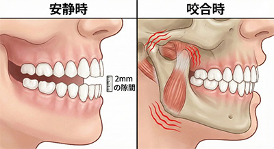 歯が触れ合わない安静時空隙と食いしばりによる顎への負担