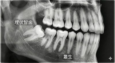 斜めに生えた親知らずが歯並びと噛み合わせを乱す仕組み