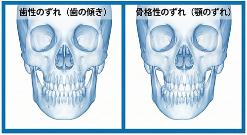 歯性のずれと骨格性の正中線不一致の比較イラスト
