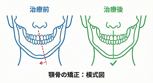 外科矯正による骨格的な正中線不一致の改善イメージ